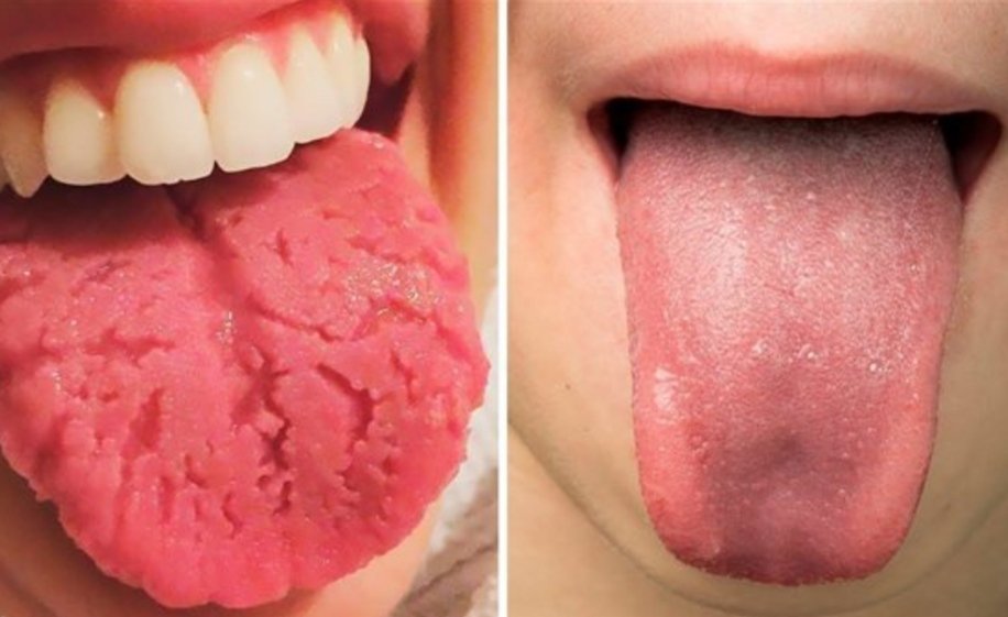 تظهر على اللسان.. أعراض تسبق حدوث الجلطات